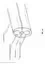 Fig. 20 - Cannula for minimizing dilution of dosing during nitric oxide delivery
