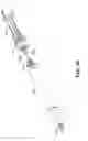 Fig. 13 - Catheter-based system for delivery and retrieval of a leadless pacemaker
