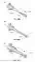 Fig. 35 - Catheter-based system for delivery and retrieval of a leadless pacemaker