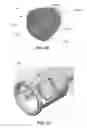 Fig. 45 - Catheter-based system for delivery and retrieval of a leadless pacemaker