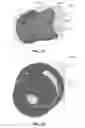 Fig. 48 - Catheter-based system for delivery and retrieval of a leadless pacemaker
