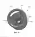 Fig. 47 - Catheter-based system for delivery and retrieval of a leadless pacemaker