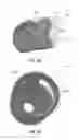 Fig. 48 - Catheter-based system for delivery and retrieval of a leadless pacemaker