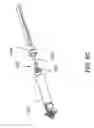Fig. 17 - Catheter-based system for delivery and retrieval of a leadless pacemaker
