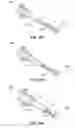 Fig. 35 - Catheter-based system for delivery and retrieval of a leadless pacemaker