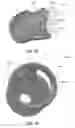 Fig. 48 - Catheter-based system for delivery and retrieval of a leadless pacemaker