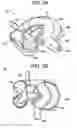 Fig. 03 - Shunt flushers and related methods