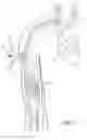Fig. 06 - Subcutaneous vascular access assemblies and related devices and methods