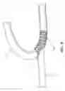 Fig. 07 - Subcutaneous vascular access assemblies and related devices and methods