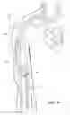 Fig. 10 - Subcutaneous vascular access assemblies and related devices and methods