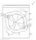 Fig. 01 - Long-term wear electrode