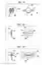 Fig. 07 - Securing an implanted medical device in a patient