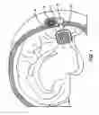 Fig. 02 - Aggregate electrode for neural stimulation