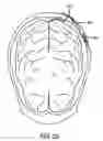 Fig. 15 - Aggregate electrode for neural stimulation