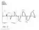 Fig. 13 - Method and system for cardiac pacing and defibrillation