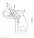 Fig. 09 - Bristled winch-guide