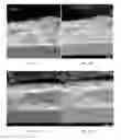 Fig. 16 - METAL DEPOSITS, COMPOSITIONS, AND METHODS FOR MAKING THE SAME