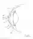 Fig. 06 - Tear shaping for refractive correction