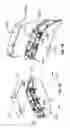 Fig. 03 - HEARING DEVICE AND A METHOD FOR PROTECTING COMPONENTS OF A HEARING DEVICE