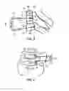 Fig. 04 - DISTRACTION TOOLS FOR SPINAL SURGERY