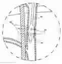 Fig. 01 - Devices and methods for treatment of heart failure by splanchnic nerve ablation