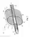 Fig. 08 - Stenosis prevention and ablation delivery system