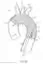 Fig. 08 - Introducer sheath with embolic protection