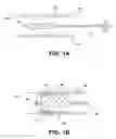 Fig. 02 - Medical device fixation anchor having improved compaction and delivery