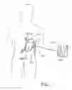 Fig. 02 - BALLOON SYSTEM AND METHODS FOR TREATING OBESITY