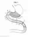 Fig. 02 - Devices and methods for modulating intestinal flow