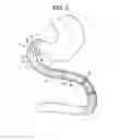 Fig. 03 - Devices and methods for modulating intestinal flow