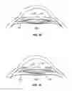 Fig. 26 - Laser eye surgery system