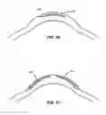 Fig. 32 - Laser eye surgery system