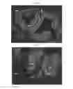 Fig. 09 - Method of treating androgen receptor negative prostate tumors and their metastases