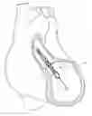 Fig. 01 - Sheath system for catheter pump
