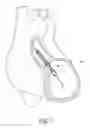 Fig. 04 - Sheath system for catheter pump