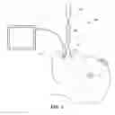 Fig. 02 - Articulating stylet