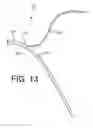 Fig. 09 - Multi-lumen indwelling catheter