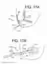 Fig. 12 - Multi-lumen indwelling catheter