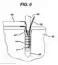 Fig. 06 - Knotless suture anchor