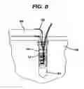 Fig. 08 - Knotless suture anchor