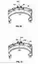Fig. 14 - Apparatus and method for tissue closure