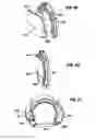 Fig. 16 - Apparatus and method for tissue closure