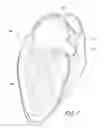 Fig. 02 - Devices and methods for excluding the left atrial appendage
