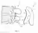 Fig. 04 - Spinal implant system and method