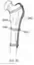 Fig. 30 - Joint repair system
