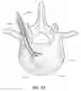 Fig. 09 - Articulating osteotome with cement delivery channel