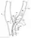 Fig. 01 - METHODS AND DEVICES FOR CRYOGENIC CAROTID BODY ABLATION