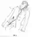 Fig. 02 - METHODS AND DEVICES FOR CRYOGENIC CAROTID BODY ABLATION