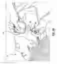 Fig. 04 - METHODS AND DEVICES FOR CRYOGENIC CAROTID BODY ABLATION